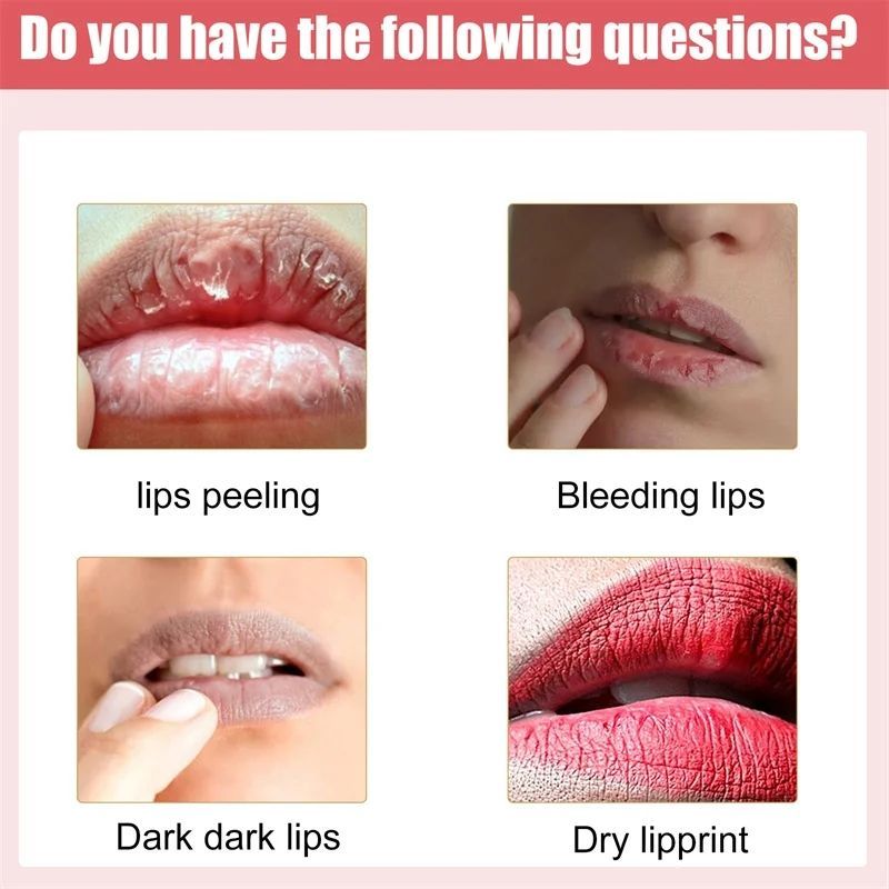 Lips Pink Fresh Lightening Bleaching Cream Treatment Remove Dark Smoke Lips Lip Balm Whitening Moisturizer Nourishing Essence B2-917