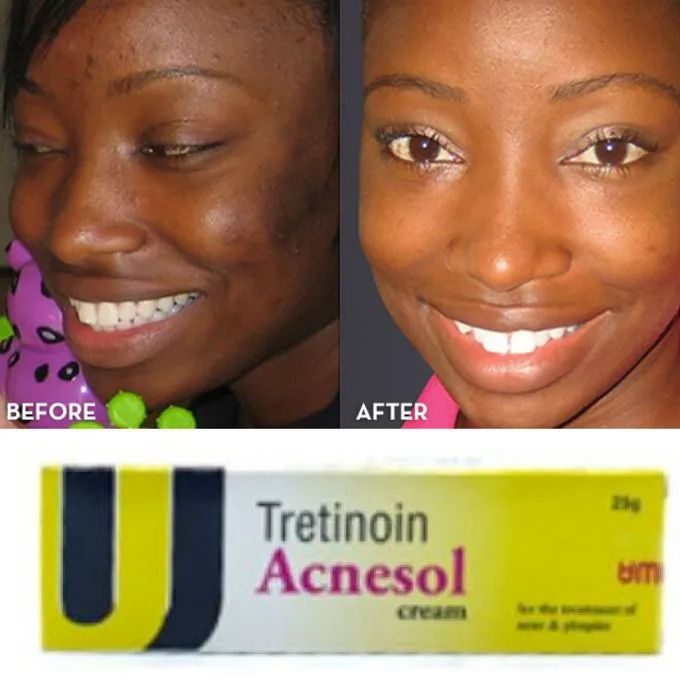 Tretinoin Acnesol Cream For Acne, Pimples And Wrinkles