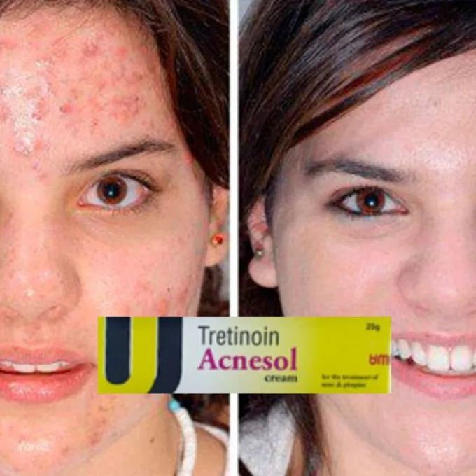 Tretinoin Acnesol Cream For Acne, Pimples And Wrinkles