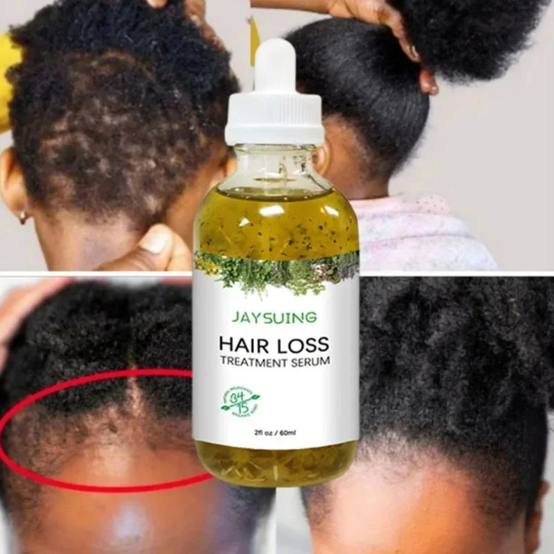 Rosemary Hair Growth Serum Anti Hair Loss Prevent Baldness Hair Care Essential Oil Scalp Treatment Beauty Health Care Men Women