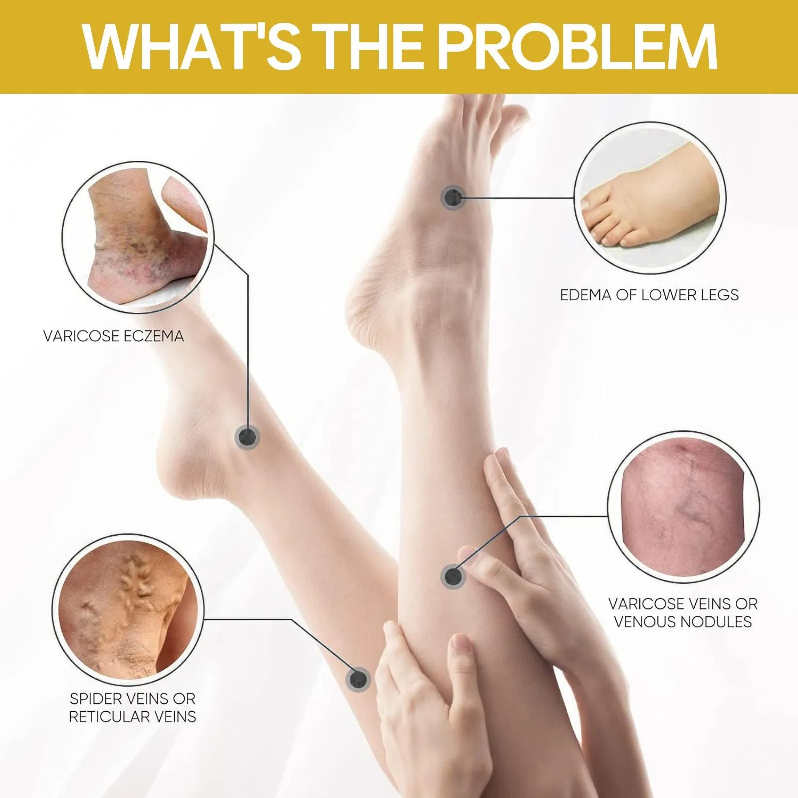 Bee Poison Varicose Vein Ease Paste, Spider Veins Ease For Legs Skin, Improve Blood Circulatio Healthy Gifts for Men & Women