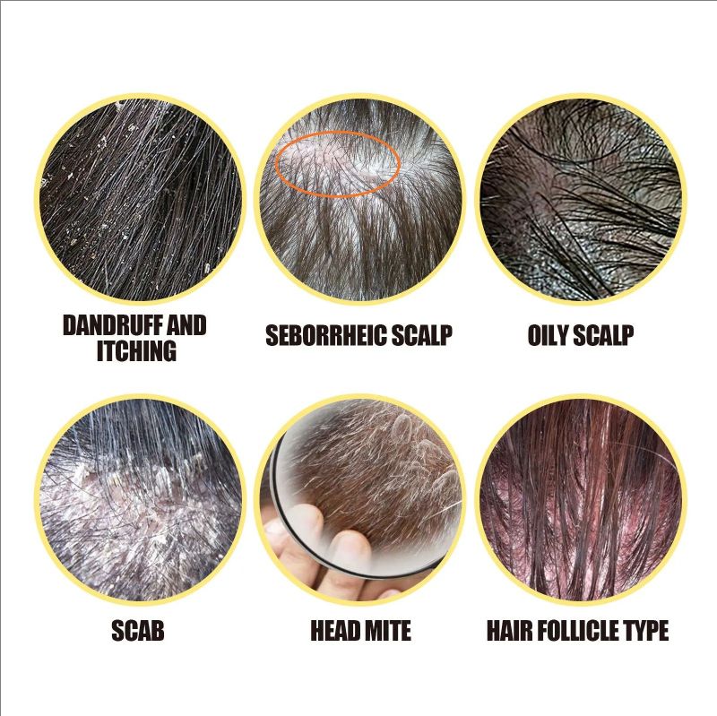 Sulphur Shampoo Itching Scalp Deep Clean Dandruff Long-Lasting Oil Control Strengthening Repair Improve Growth Hair Care Shampoo