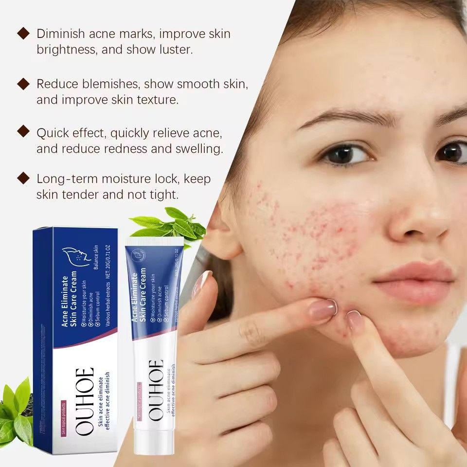 Pimple Acne Treatment Face Cream Nourish Balance Oil Control Refreshing Repair Pimple Remover Acne Cleansing Cream 20g/pc