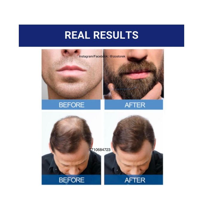 Kirkland Minoxidil 5% extra strength hair loss regrowth system treatment for men Beard care oil premium Topical Solution Growth Nourishing Serum 1 bottle of 60ml (1 month supply)