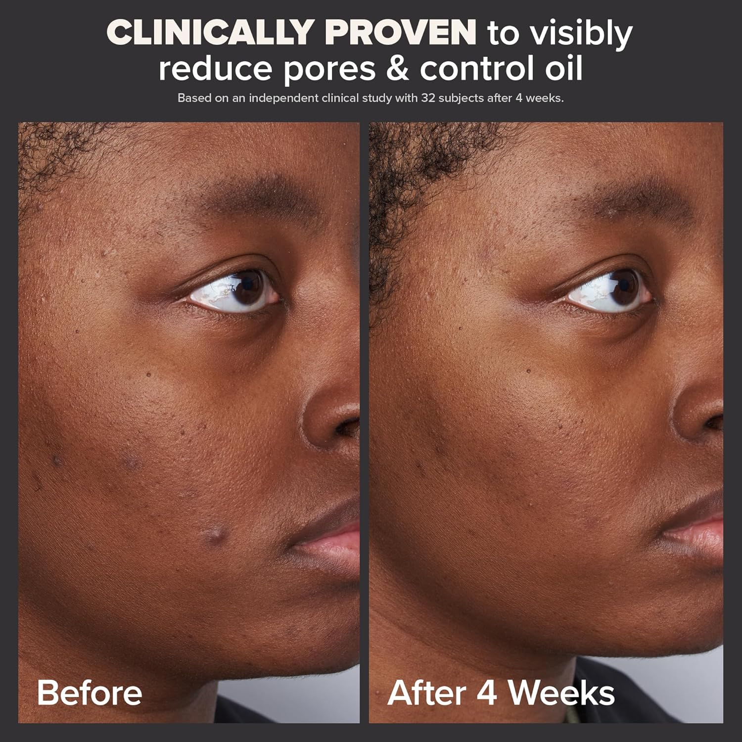 PAULA'S CHOICE SALICYLIC ACID Skin Perfecting 2% BHA Liquid Exfoliant - Rapid Hydrating Super Glowing Skin Tone