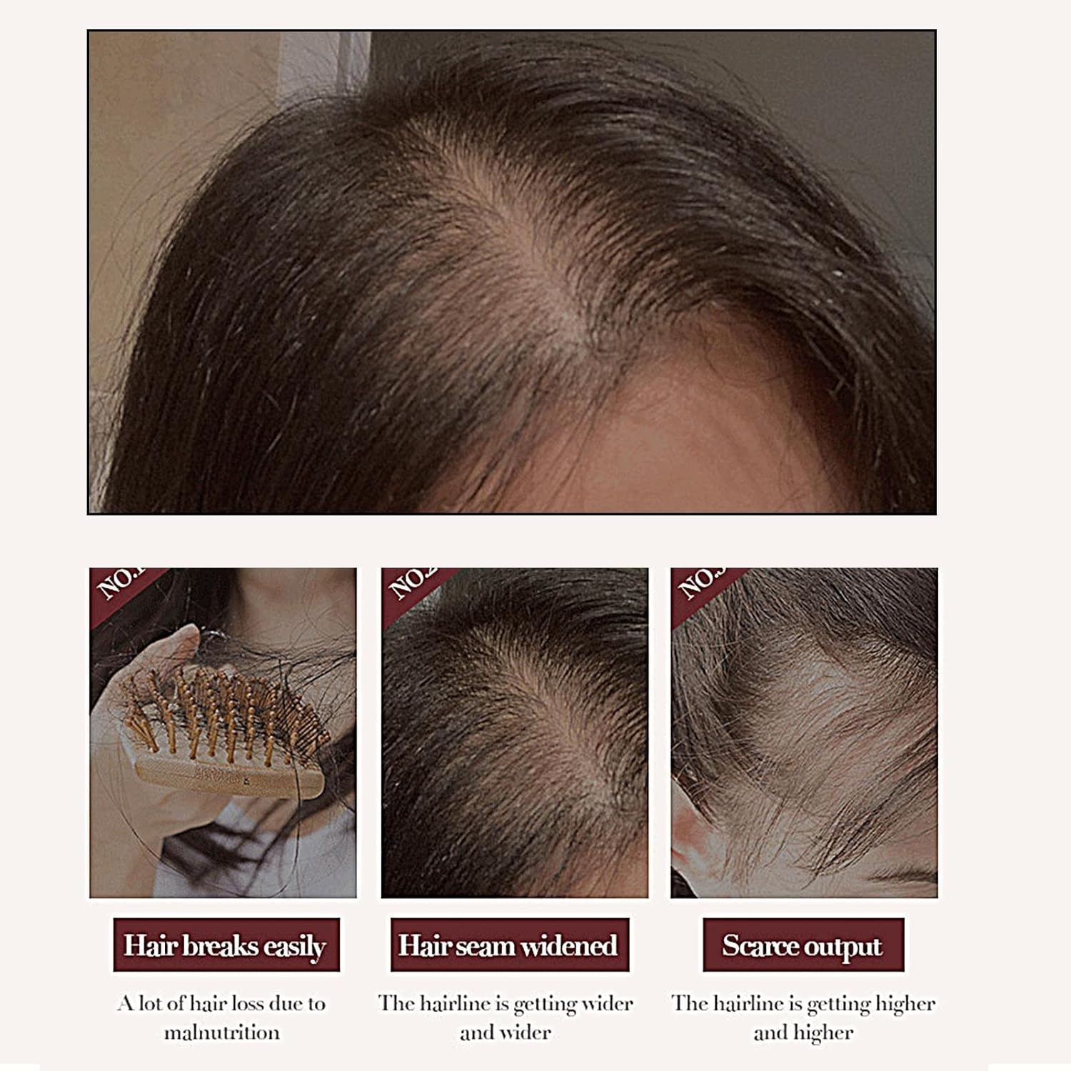 SADOER Anti Hair Loss Treatment Shampoo Essence, Hair Growth Ginger Extract Beard Growth,Hair Growth, Anti Dandruffs Hair Moisturizing Hair Care Shampoo, Derma Roller Compliment In Anti Hair Loss