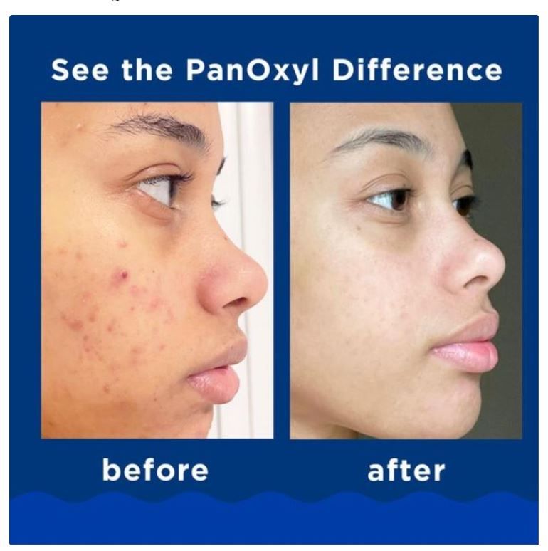 PanOxyl Acne Foaming Wash 10% Benzoyl Peroxide – Maximum Strength Acne Treatment Wash for Face & Body | Deep Pore Cleanser for Acne-Prone Skin | 5.5 oz