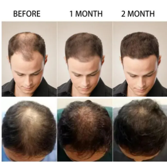 Sadoer Hair Care Serum, Ginger Hair Growth Based Product, Effective in Hair Growth,Moisturizing and Softening Forked Hair, with ScalpCare ingridients