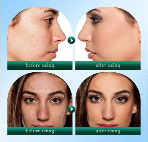 Sadoer Tea Tree Acne & Oil Control Face Cream | Breakout Defense + Matte Hydration for Clear, Balanced Skin