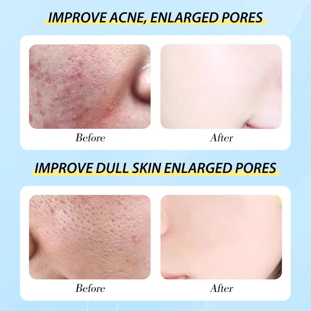 SALICYCLIC ACID PORE SHRINKING SERUM QUICK REMOVE BLACKHEADS SMOOTH SKIN TIGHTEN FACE ELIMINATES LARGE PORES KOREAN PRODUCT