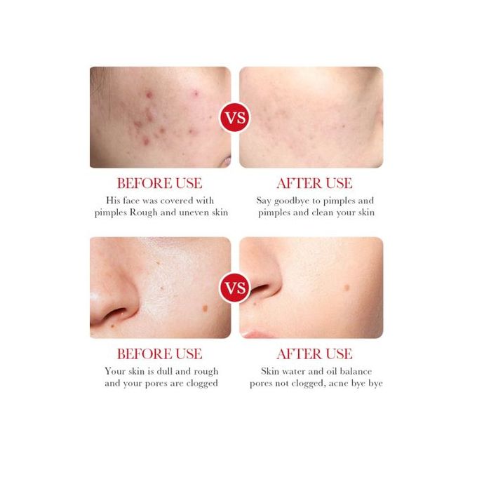 BIOAQUA Bioaoua Salicylic Acid Acne Removal Cream Fades Acne Marks, Eliminates Pimples, Remove Acne, Soothes Redness, Shrink Pores 20g