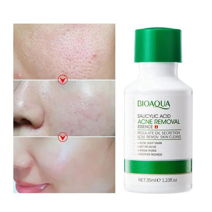 BIOAQUA 3 in 1,Salicylic Acid Acne Treatment,Oil Control Combo, Salicylic Cleanser+Salyclic Essence +Cream 20g Fades Acne Marks, Eliminates Pimples, Soothes Redness, Shrink Pores Black Heads, Pimples
