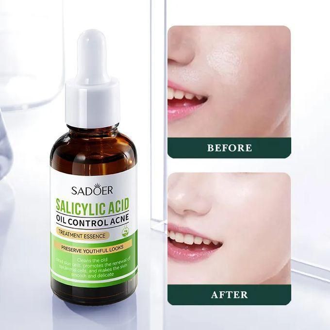 SADOER Salicylic Acid Serum for Face Shrink Pores, Gentle Exfoliating, Salicylic Acid for Anti Acne, Pimple, Spot, Blackhead Salicylic Acid Acne Treatment Essence_30ml