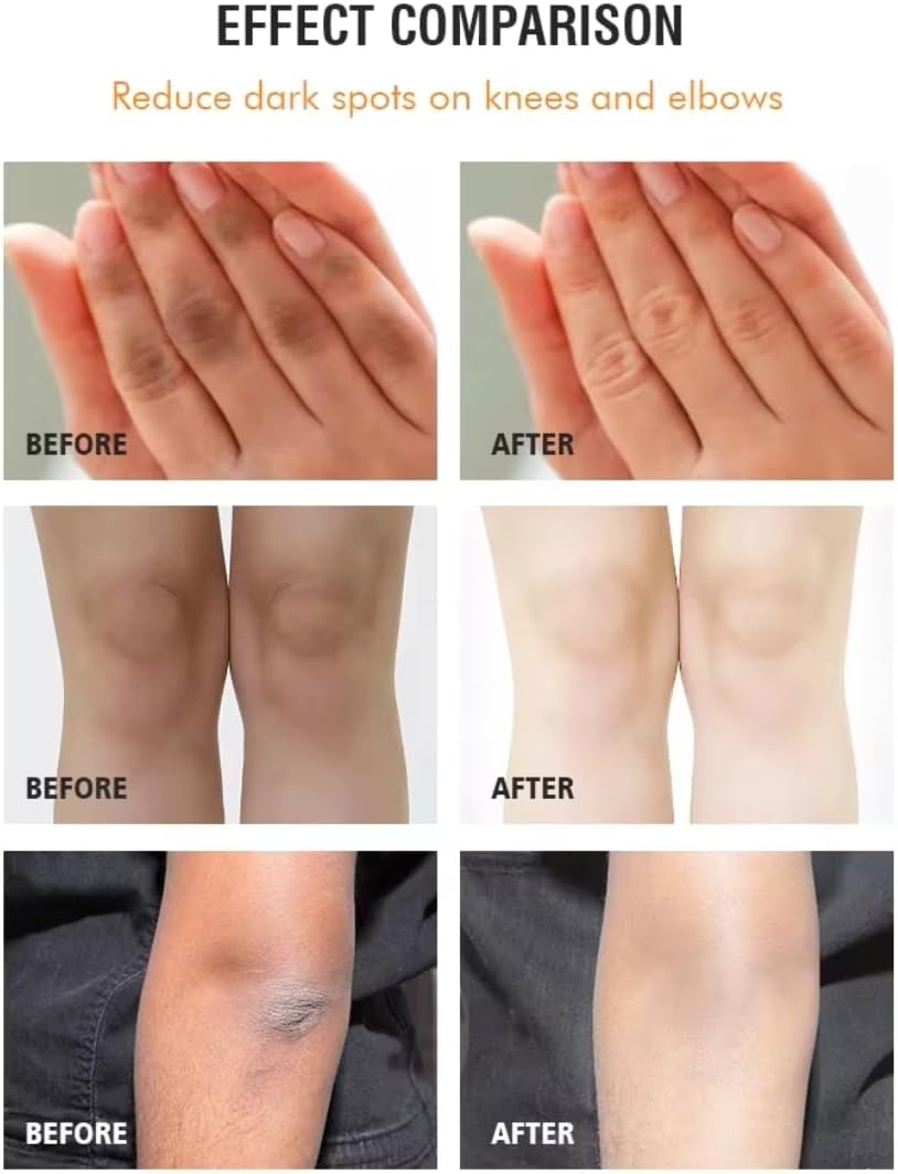 Dark Knees & Elbows Whitening Cream 120G, Underarm Dark Armpit Dark Spot Brightening Whitening Cream, Whiten Dark Knuckles, Strong Skin Whitening for Women & Men, Nourish Moisturize Scars