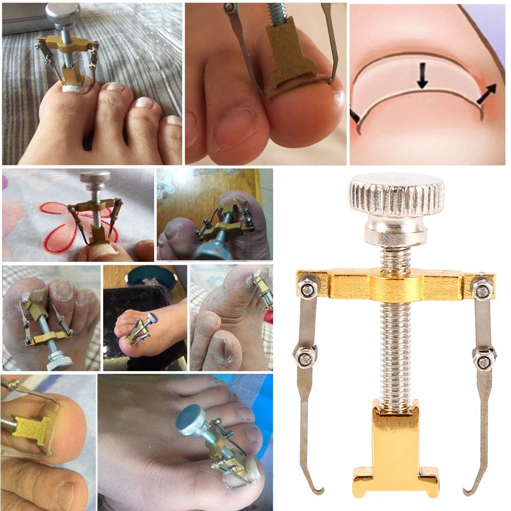 Ingrown Nail Corrector,Professional Ingrown Toe Nail Correction Kit Pedicure Toes Treatment Tools Set for Paronychia (Ingrown Nail Corrector)