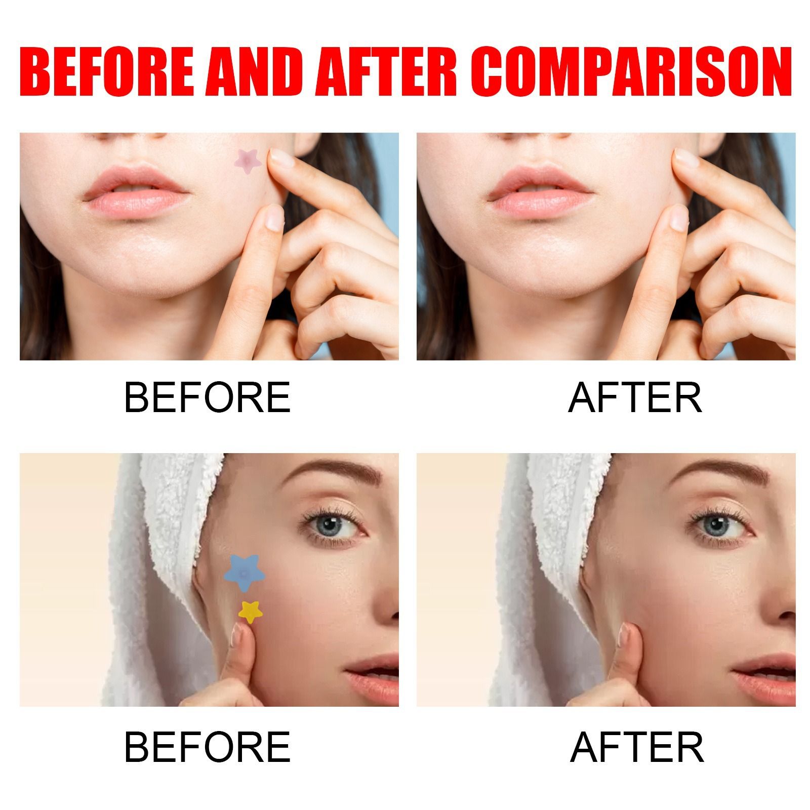 200pcs Pimple Patch Repair Acne Patch Facial Skin Care Fade Blemishes Pimple Marks Closed Acne Blemishes Cover Acne Pimple Repair Patch
