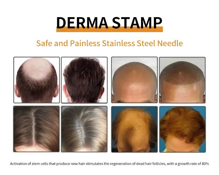 Derma Stamp Microneedle Adjustable 100 Micro Needles Length for Face / Hair /Beard /Scalp Hair Growth Stainless Steel