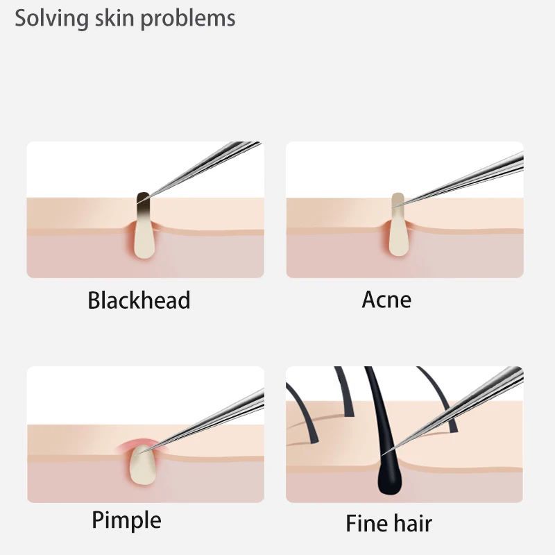 11pcs Acne Blackhead Removal Needles Stainless Steel Black Spot Blemish Pimple Removal Needle Deep Cleansing Tool Face Skin Care Kit