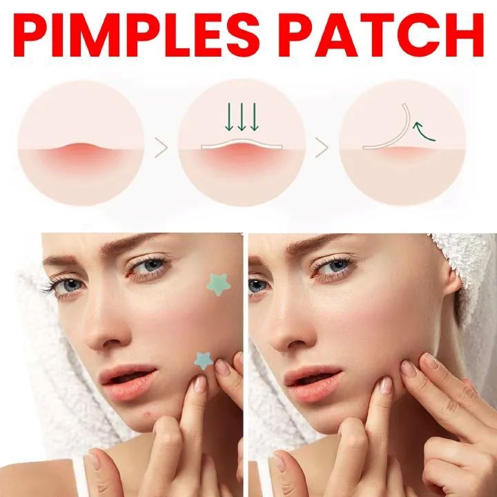 200pcs Pimple Patch Repair Acne Patch Facial Skin Care Fade Blemishes Pimple Marks Closed Acne Blemishes Cover Acne Pimple Repair Patch Acne Treatment Devices