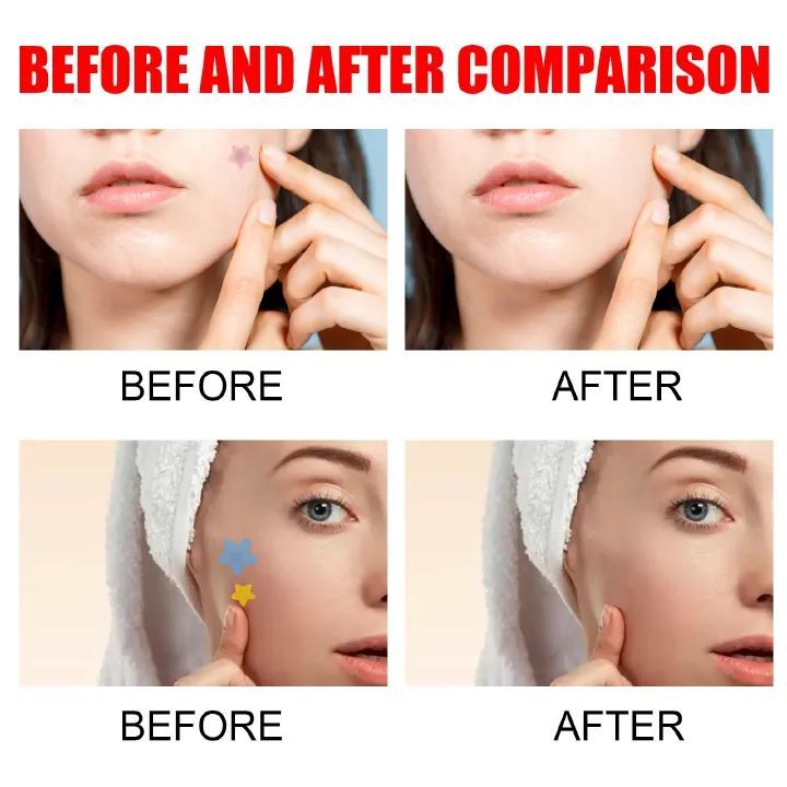200pcs Pimple Patch Repair Acne Patch Facial Skin Care Fade Blemishes Pimple Marks Closed Acne Blemishes Cover Acne Pimple Repair Patch Acne Treatment Devices
