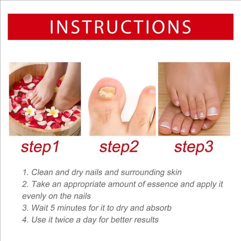 20ml Nail Care Essence-Liquid, Repairing Yellowing And Thickening Gray Nails Of Hands And Feet, Nail Decay Moisturizing Liquid