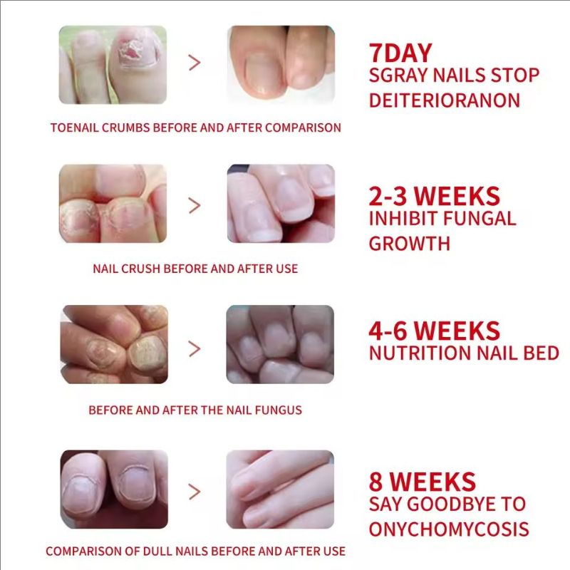 20ml Nail Care Essence-Liquid, Repairing Yellowing And Thickening Gray Nails Of Hands And Feet, Nail Decay Moisturizing Liquid