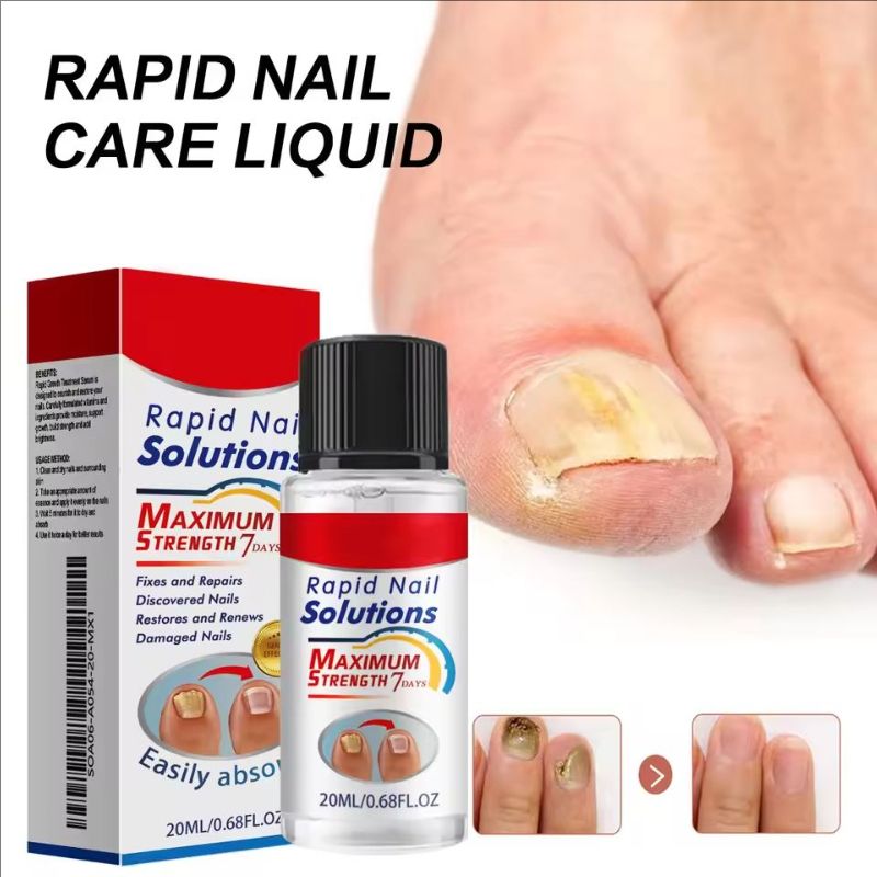 20ml Nail Care Essence-Liquid, Repairing Yellowing And Thickening Gray Nails Of Hands And Feet, Nail Decay Moisturizing Liquid