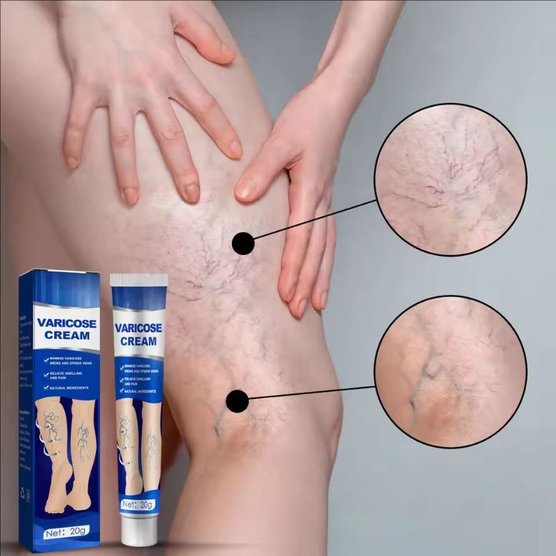 Venoheal Varicose Vein Ease Paste Varicose Veins Paste Varicose And Spider Veins Ease For Legs Improve Blood Circulatio