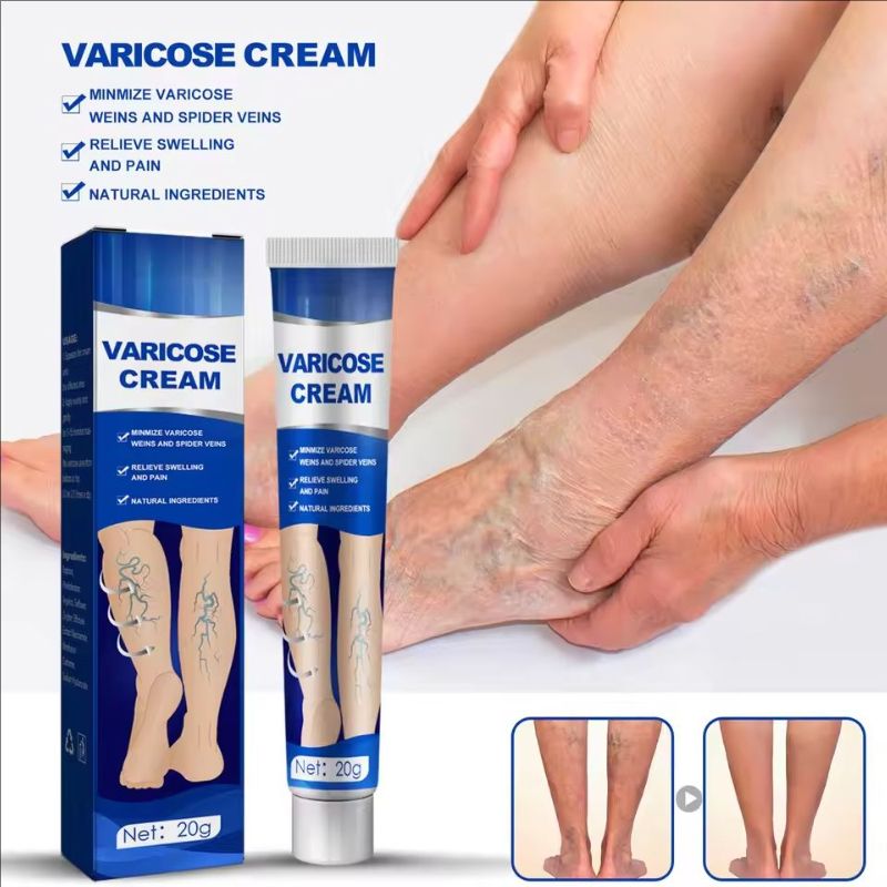 Venoheal Varicose Vein Ease Paste Varicose Veins Paste Varicose And Spider Veins Ease For Legs Improve Blood Circulatio