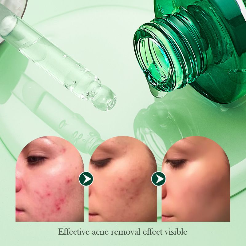 Tea Tree Acnes Oil Control Anti-Acne Gel Cleanser Face Cream Face  Serum  Facial Masks