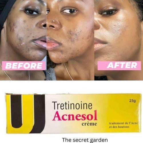 Acnesol tretinoin Cream 25g - Powerful Acne Treatment For Clearer, Smoother Skin