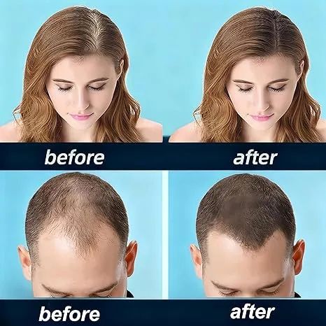 1pcs 5% Minoxidil Tincal Hair Growth Oil Dense Hair Growth Serum Scalp Nutrients