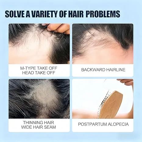 1pcs 5% Minoxidil Tincal Hair Growth Oil Dense Hair Growth Serum Scalp Nutrients
