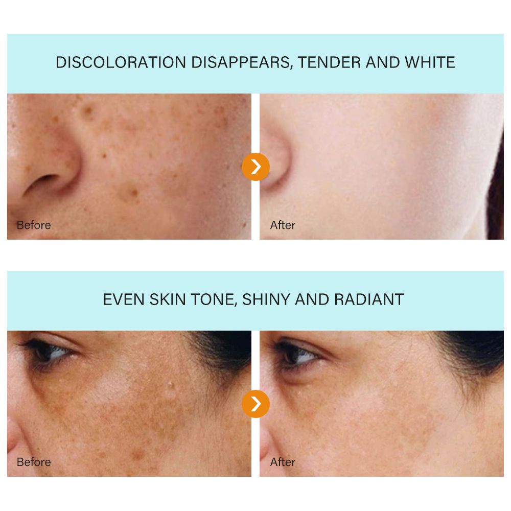 Lighten Fine Lines On Face, Moisturize Around Eyes, Firming, Brightening And Removing Freckles  Creams & Moisturizers