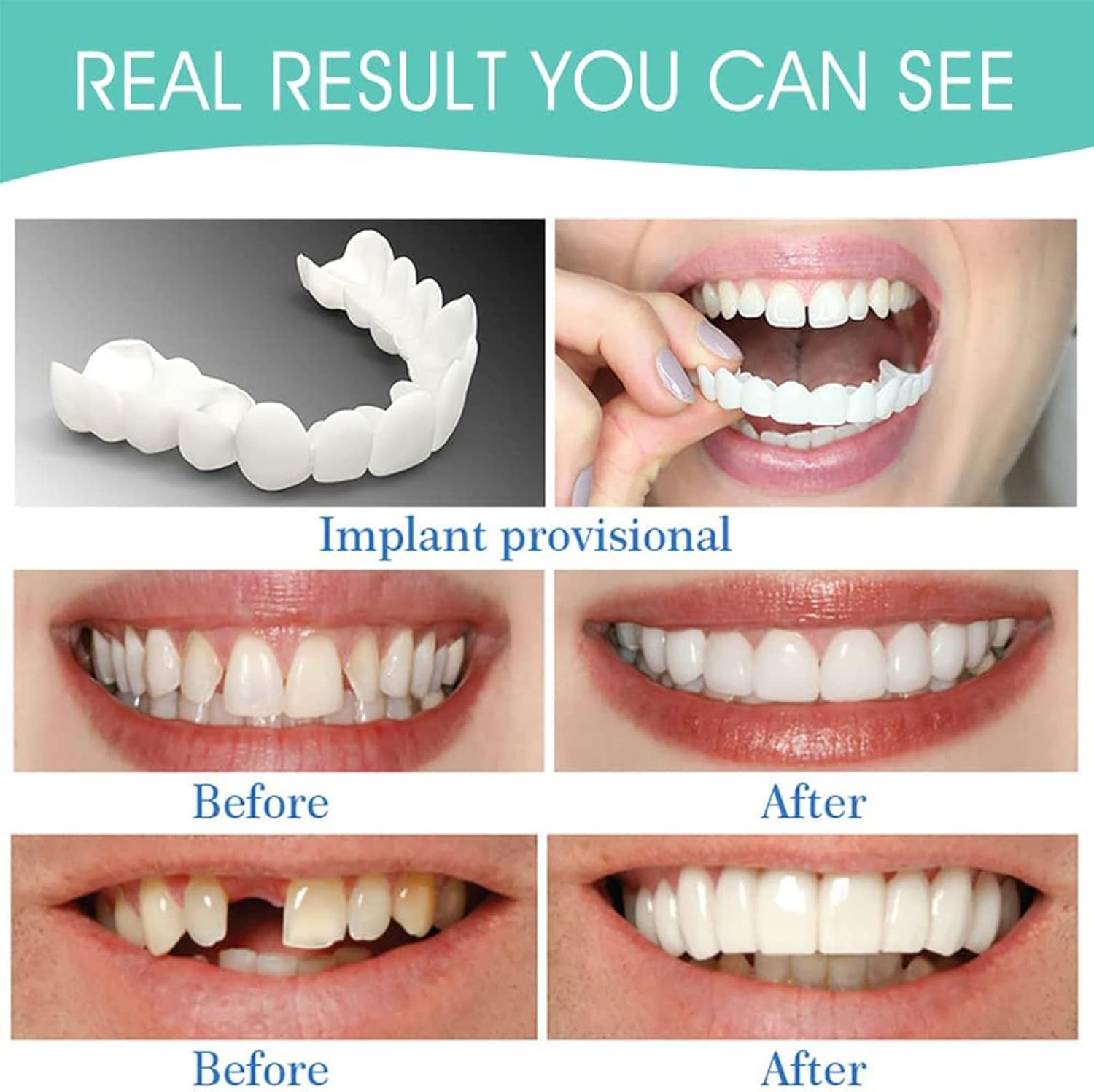 SXCHEN 2 Pairs Denture Care Tooth Whitening FakeTooth Jacket Simulation Braces Upper Teeth The Second Generation of The Teeth the Sixth Generation With Hole Simulation Braces Whitening Fake Braces Ora