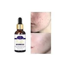 Aichun Beauty Anti-Acne Facial Face Serum With Salicylic Acid & Aloe Vera-30ml