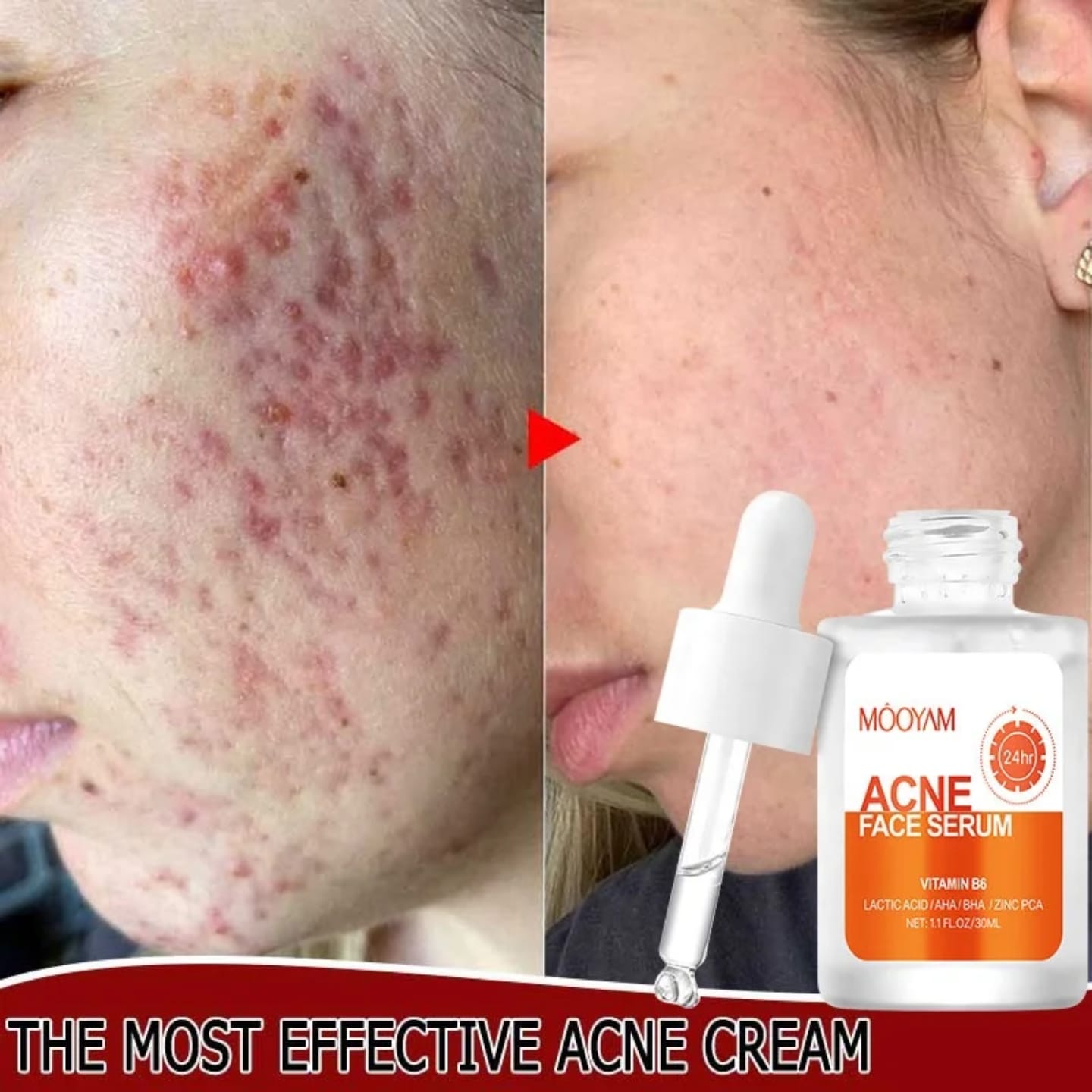 [Verified Original] Mooyam 3-in-1 Acne Treatment Set - AHA/BHA & Salicylic Acid Formula for Clear Skin, Oil Control & Pimple Removal