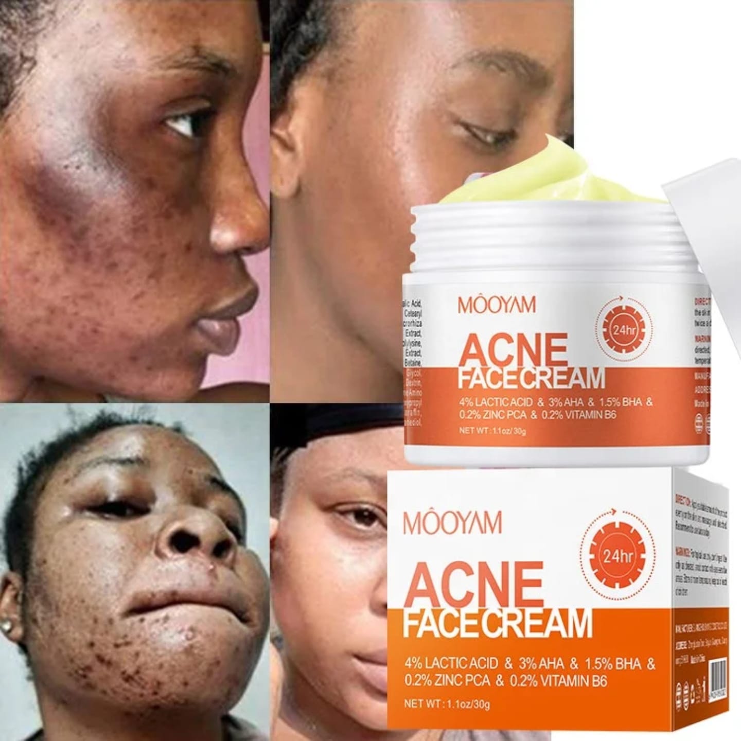 [Verified Original] Mooyam 3-in-1 Acne Treatment Set - AHA/BHA & Salicylic Acid Formula for Clear Skin, Oil Control & Pimple Removal
