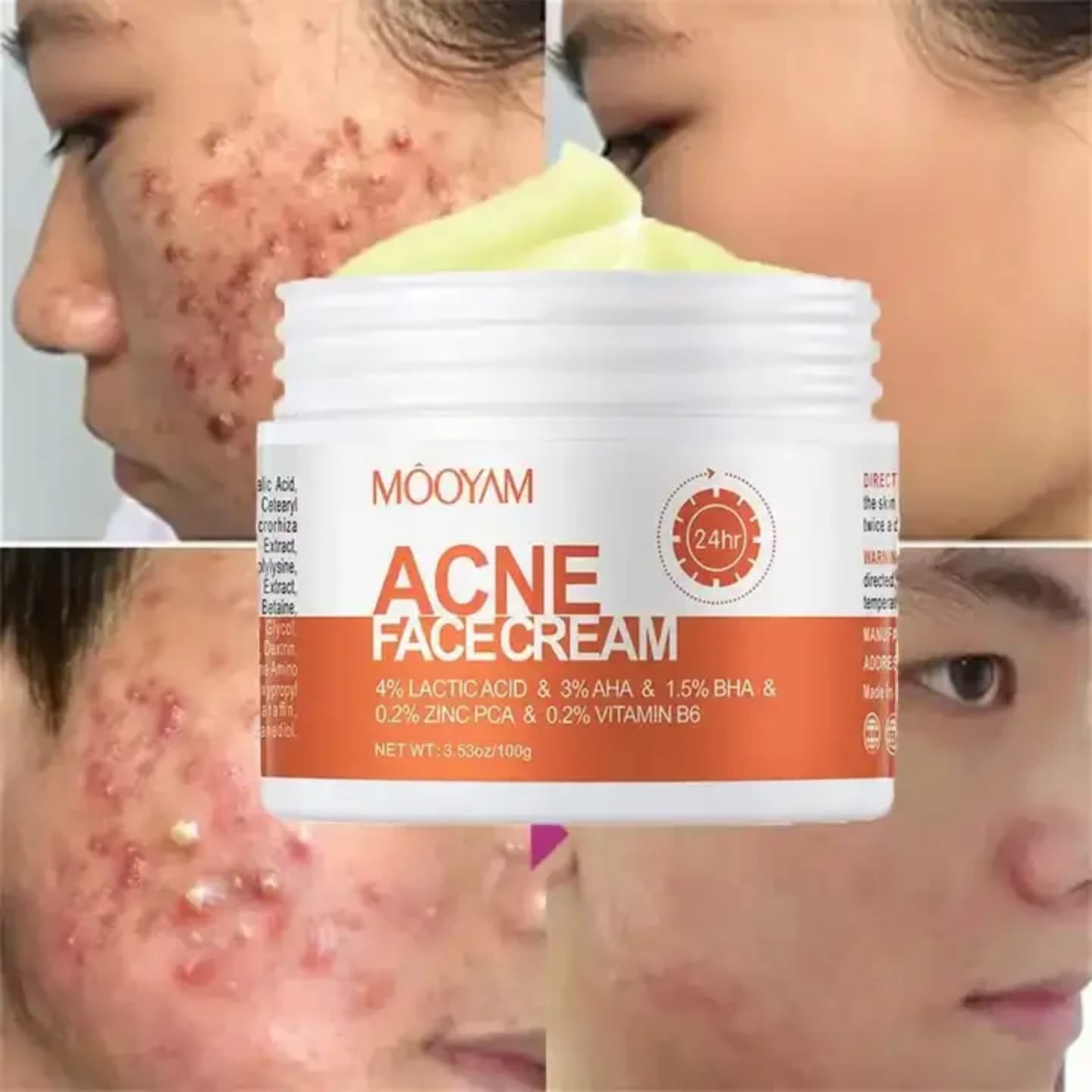 Best price for Mooyam acne face treatment cream for pimple and acne ...