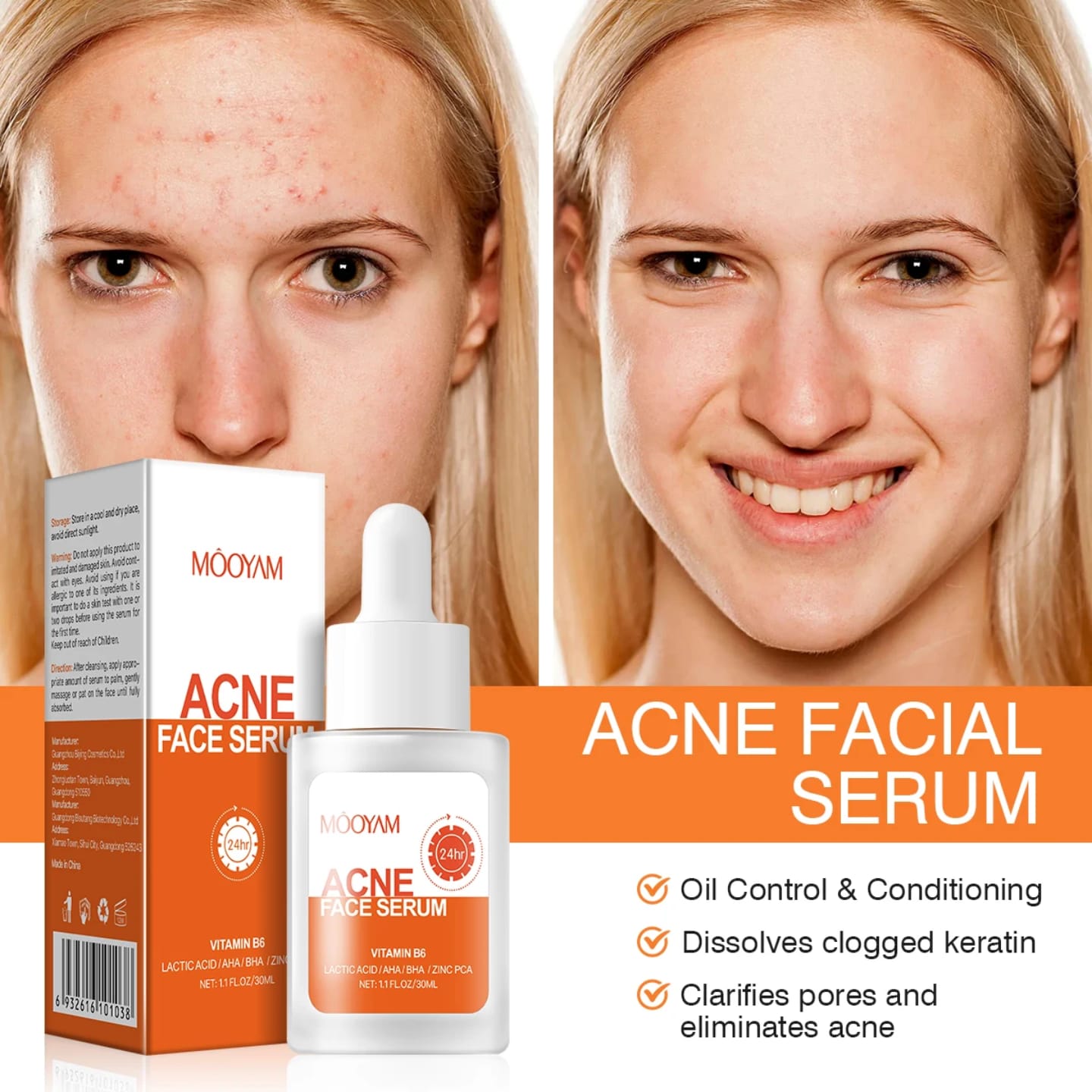 MOOYAM Acne Serum: Your Double Agent Against Breakouts Fade post-acne scars for even tone skin, Dissolve pore-clogging oil & dirt and Calm redness & reduce inflammation