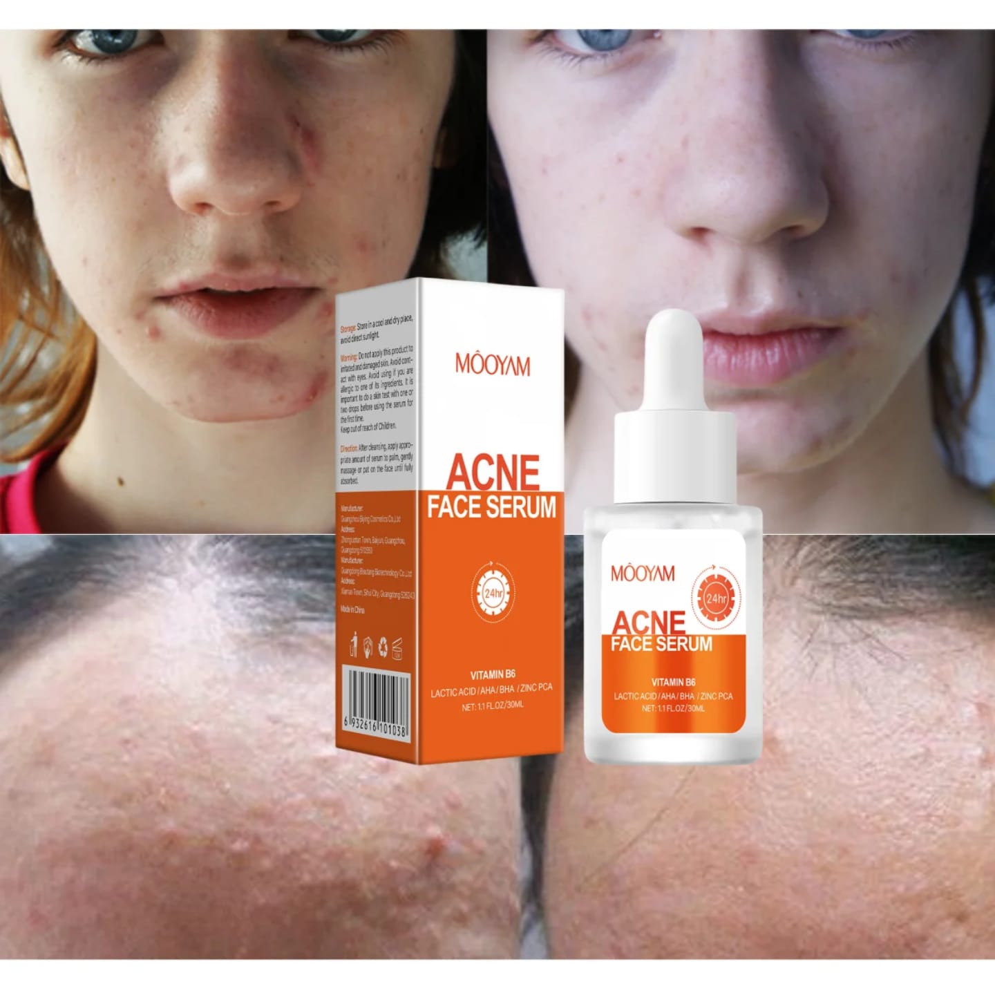 MOOYAM Acne Serum: Your Double Agent Against Breakouts Fade post-acne scars for even tone skin, Dissolve pore-clogging oil & dirt and Calm redness & reduce inflammation