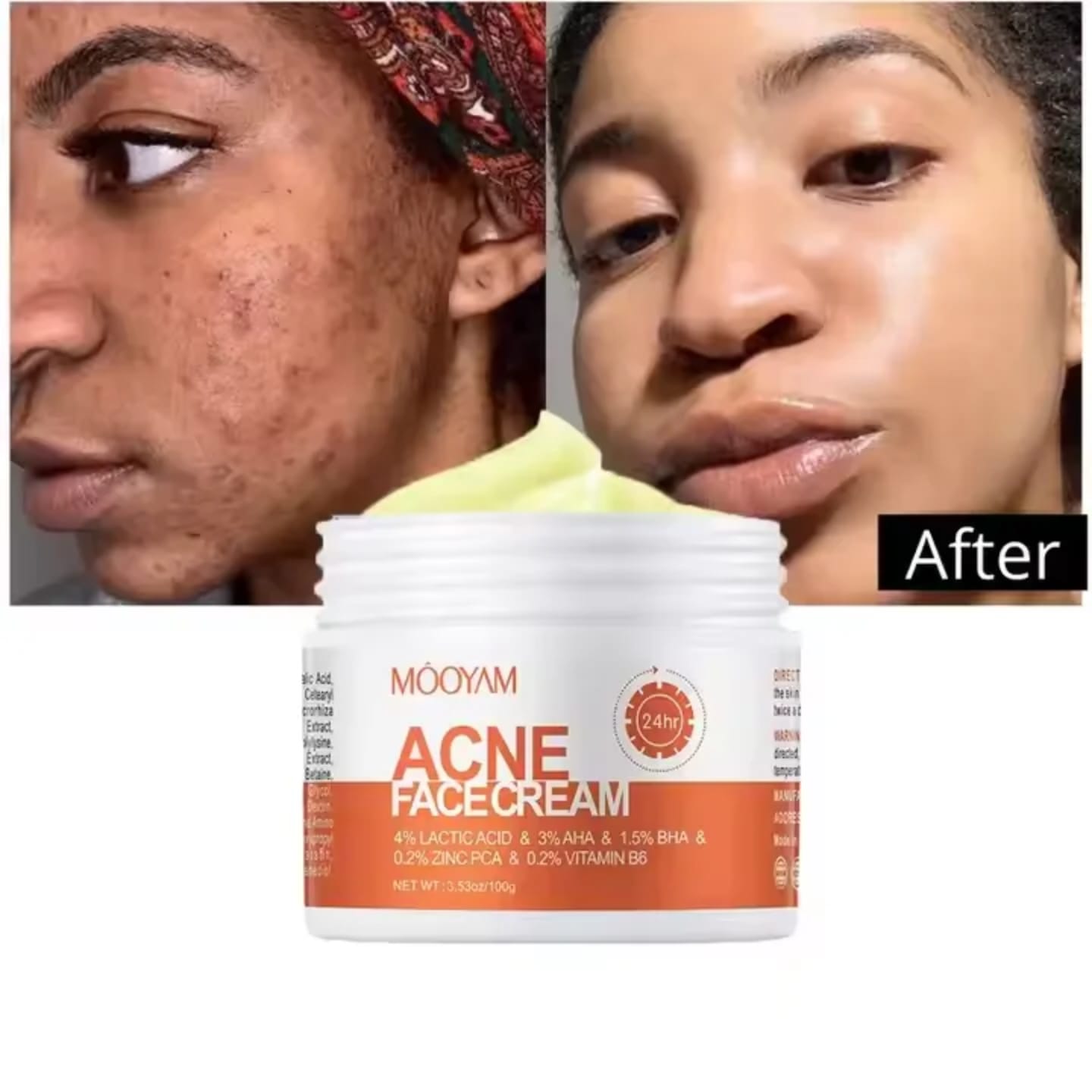 Mooyam Acne treatment Face Cream – Acne Treatment, Blemish Control, Exfoliating Cream for Clear Skin 30g Fast Delivery In Stock