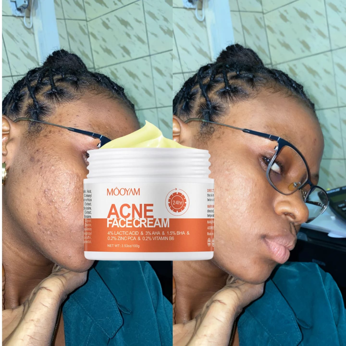 Mooyam Acne treatment Face Cream – Acne Treatment, Blemish Control, Exfoliating Cream for Clear Skin 30g Fast Delivery In Stock
