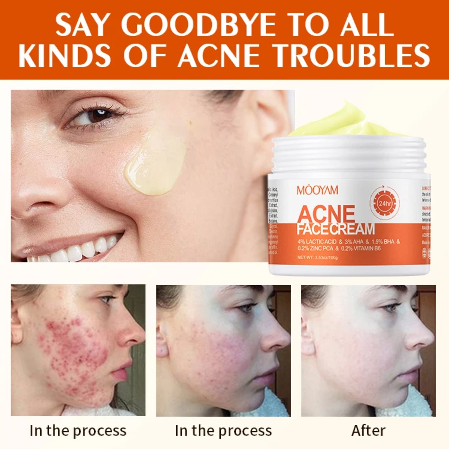 Mooyam Acne treatment Face Cream – Acne Treatment, Blemish Control, Exfoliating Cream for Clear Skin 30g Fast Delivery In Stock