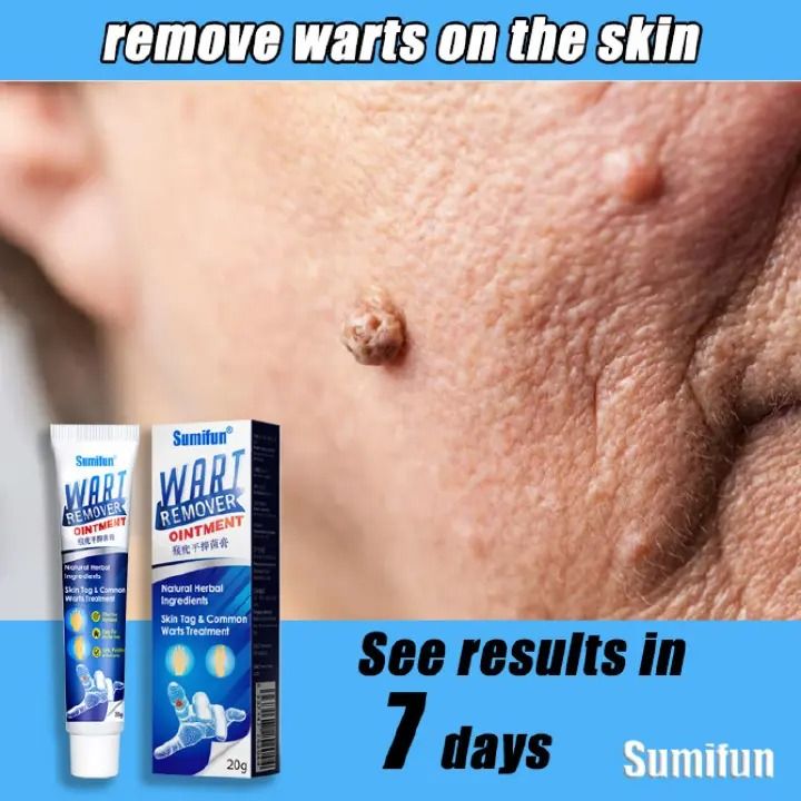 Warts Remover Ointment Wart Treatment Cream Skin Tag Remover Herbal Extract Wart Remover, Instant Blemish Removal Gel, Skin Wart Removal Cream Body Warts Treatment Cream   -