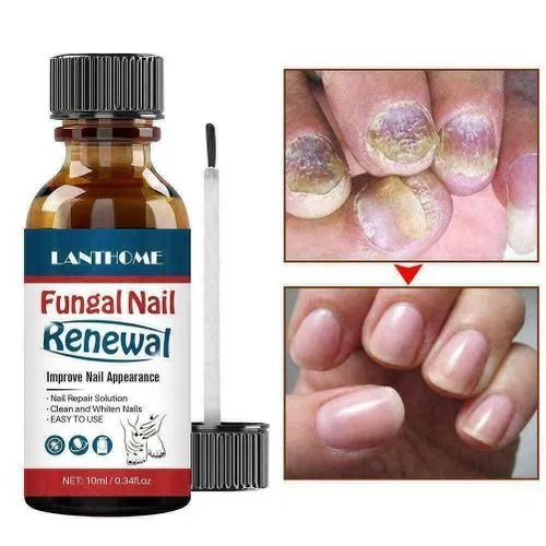 Nail Fungus Treatment Serum Foot Repair Liquid Toe Nails Fungal Removal Gel Anti Infection Paronychia Onychomycosis Cream 10ml - LANTHOME -