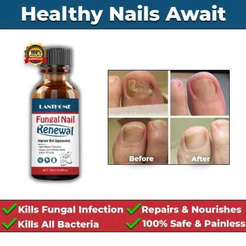 Nail Fungus Treatment Serum Foot Repair Liquid Toe Nails Fungal Removal Gel Anti Infection Paronychia Onychomycosis Cream 10ml - LANTHOME -