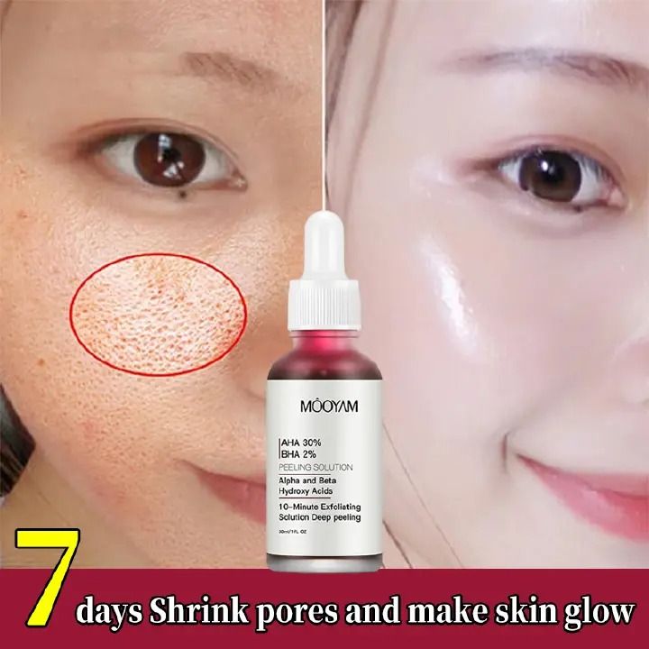 Original Peeling Sotution AHA 30%+ BHA 2% Acne Treatments Facial Serum Removal Pimples Blackhead Exfoliating Shrink Pores 30ml - MOOYAM -