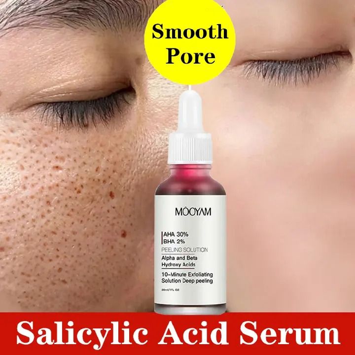 30ml Face Peeling Solution AHA 30% + BHA 2% Face Serum Fruit Acid Acne Oil Control Remove Blackheads Shrink Pores Skin Texture Improve Care - MOOYAM -