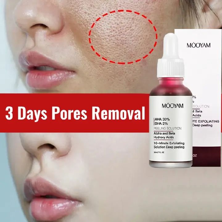30ml Face Peeling Solution AHA 30% + BHA 2% Face Serum Fruit Acid Acne Oil Control Remove Blackheads Shrink Pores Skin Texture Improve Care - MOOYAM -